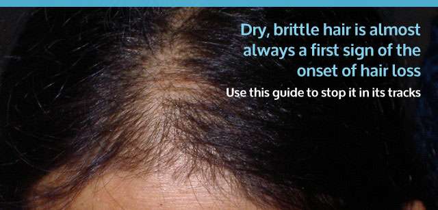 Dry Brittle Hair Female Hair Loss