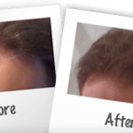 Before and after hair loss