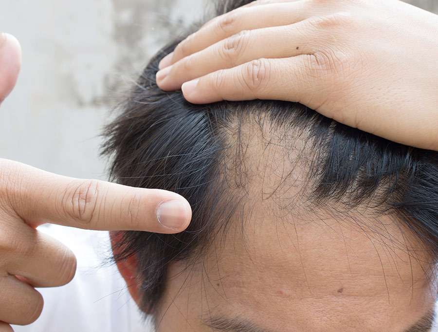 How do you reverse thinning hair?