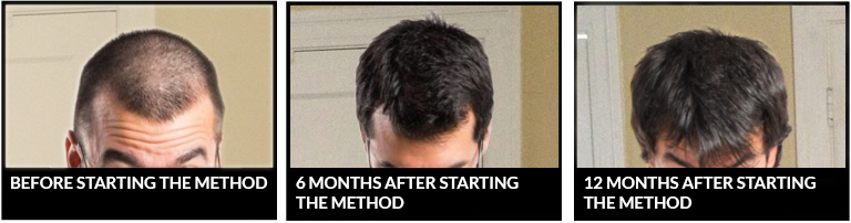 Before and after nicehair.org scalp regeneration method