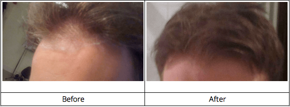 Hair growth before and after photos