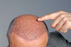 After hair transplant surgery