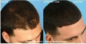 Before and after hair regrowth from PRP therapy
