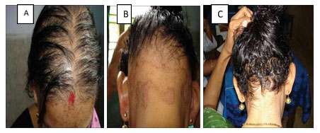 Hypothyroidism zinc and hair loss