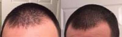 Before and after nicehair results