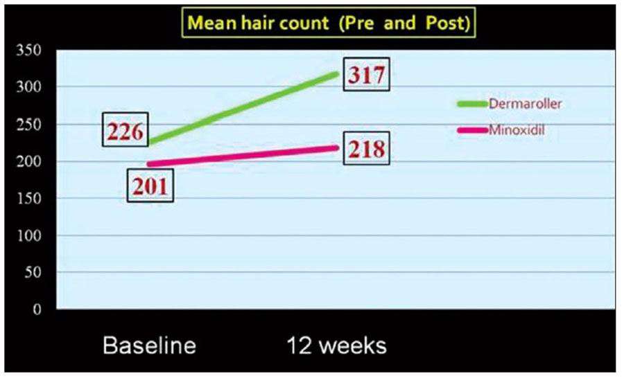 Mesotherapy hair growth results